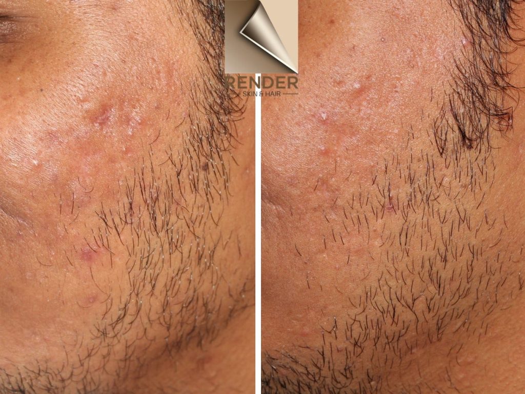 Acne Scar Removal: Real Results, Real People—Here’s What Works