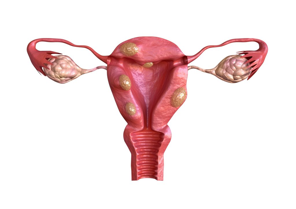 Ovarian Cysts Treatment Singapore: Which Is the Best?