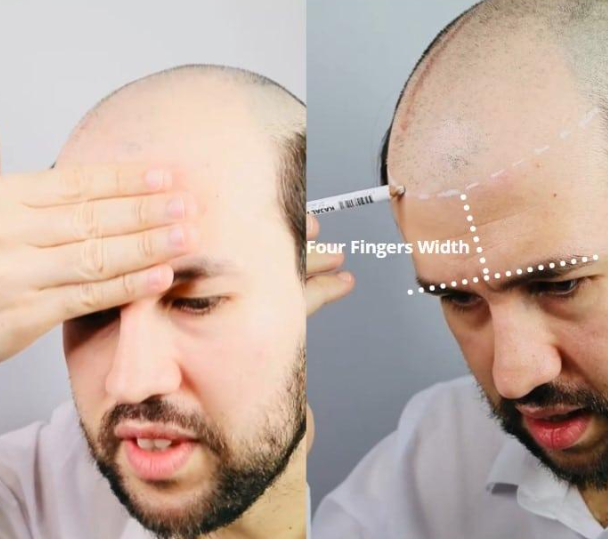 Would I Be a Good Candidate for a Frontal Hair System?